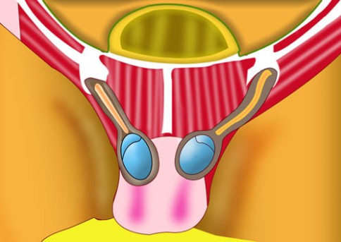 Open Umbilical Hernia Repair by OrangeCountySurgeons.org  (2)